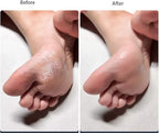 4 Pieces Double Sided Foot File Callus Remover Foot Sander Foot Scrubber Dead - Image 5