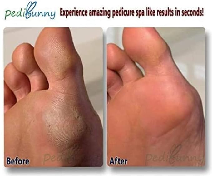 Electric Foot Callus Remover - Image 6