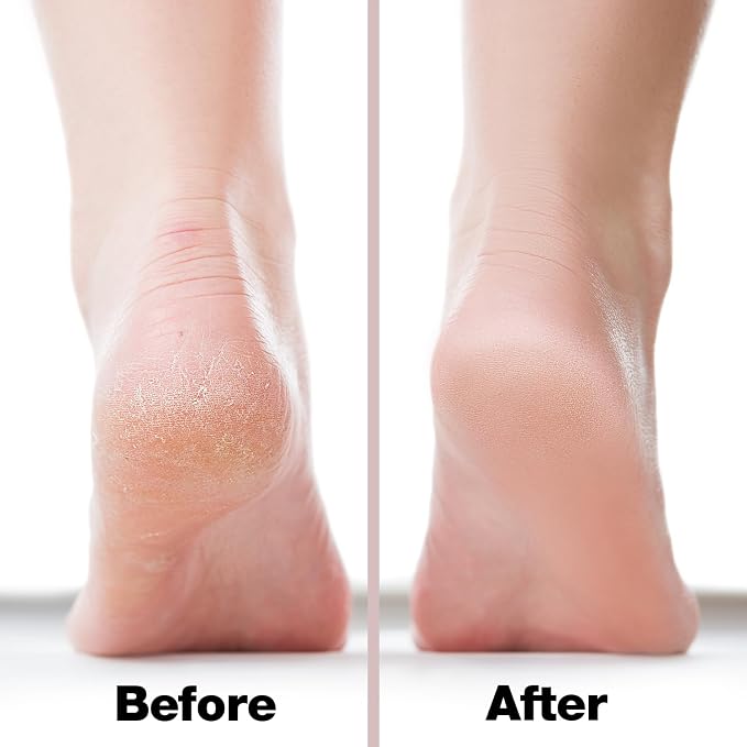 Probelle Double Sided Multidirectional Nickel Foot File Callus Remover - Image 4