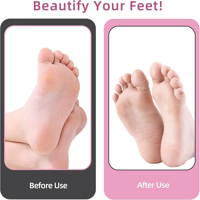 APRELM Electric Foot Callus Remover - Image 6