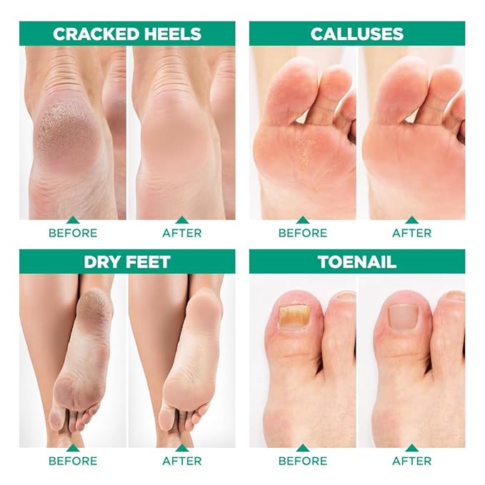 Tea Tree Oil Foot Soak with Epsom Salt - Image 6
