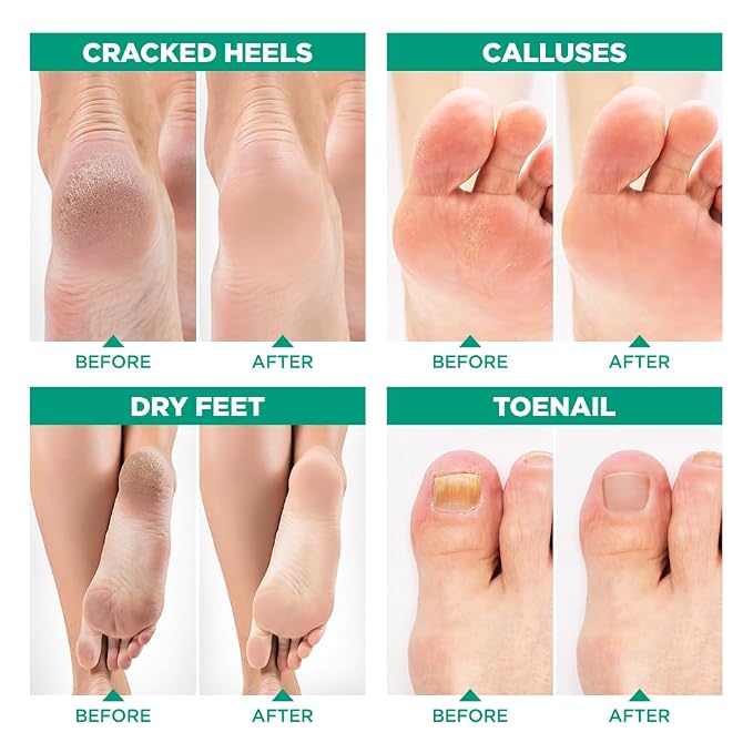 Tea Tree Oil Foot Soak and 40% Urea Cream - Image 2