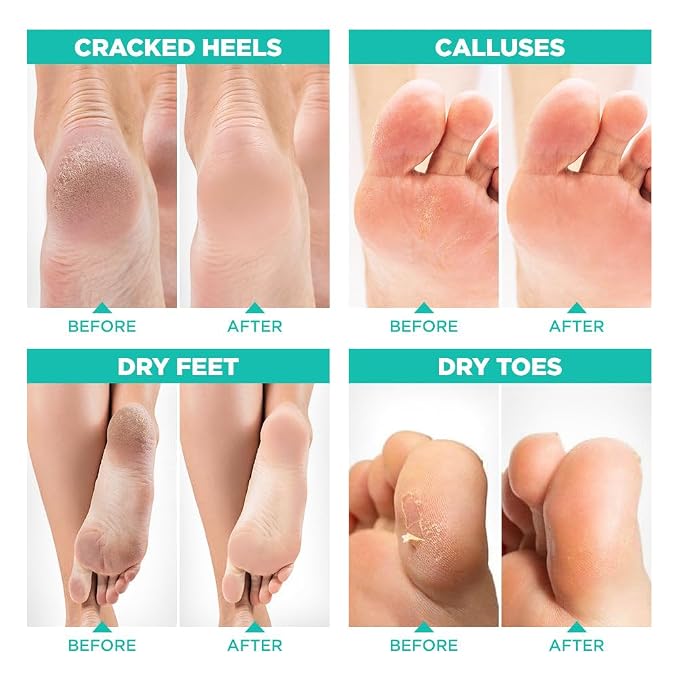 Lavinso Foot Peel Mask for Dry Cracked Feet – 2 Pack Peeling Mask Removes Dead - Image 3