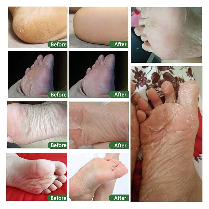 Foot Peel Mask 3 Pack， Exfoliator Peel Off Calluses Dead Skin Callus - Image 8
