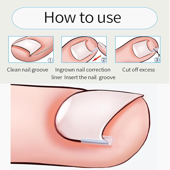 Ingrown Toenail Corrector Set - Image 5