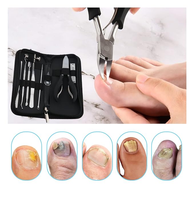Bcabo 10Pcs/set Ingrown Toenail Tools Kit, Nail Treatment Foot Tool, Ingrown - Image 3