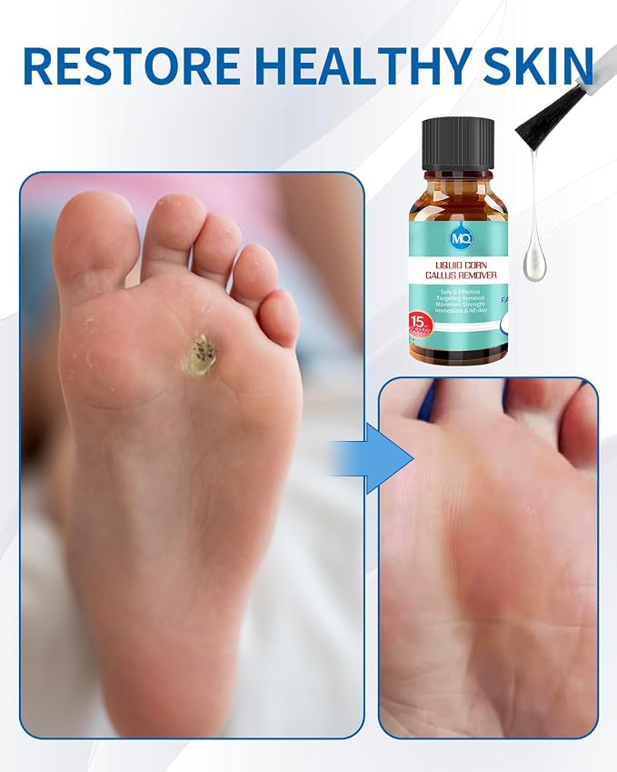 MQ Professional Corn & Callus Remover Liquid - Image 5