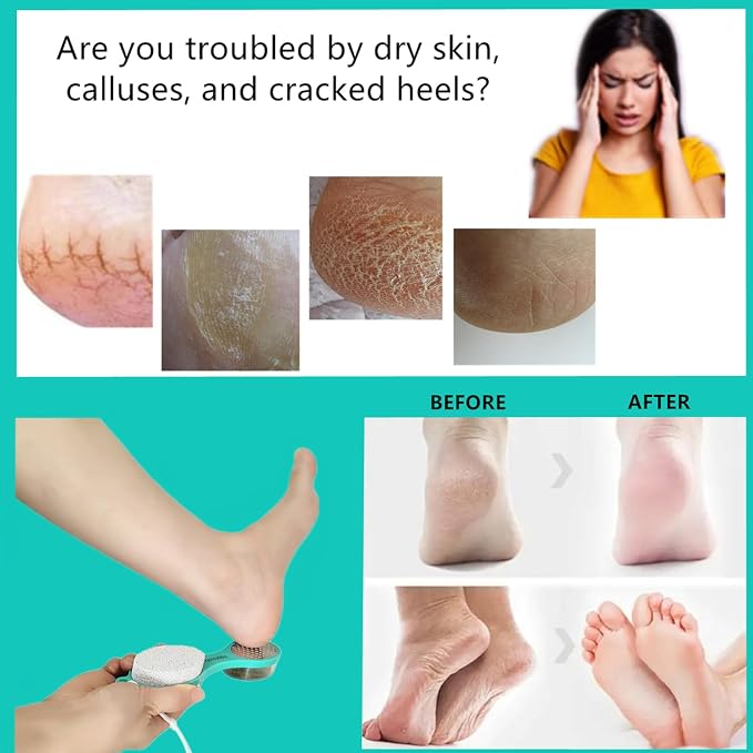 Foot File Callus Remover 5-in-1, Scrubber Brush, Stainless Steel Foot Rasp and - Image 3