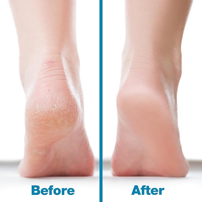 Probelle Double Sided Multidirectional Nickel Foot File Callus Remover - Image 5