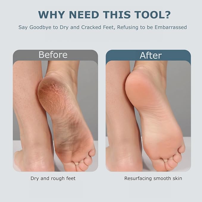 Upgraded Electric Foot Callues Remover, Portable Electric Foot Files - Image 8
