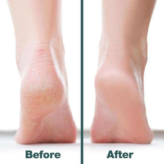 Probelle Double Sided Multidirectional Nickel Foot File Callus Remover - Image 4