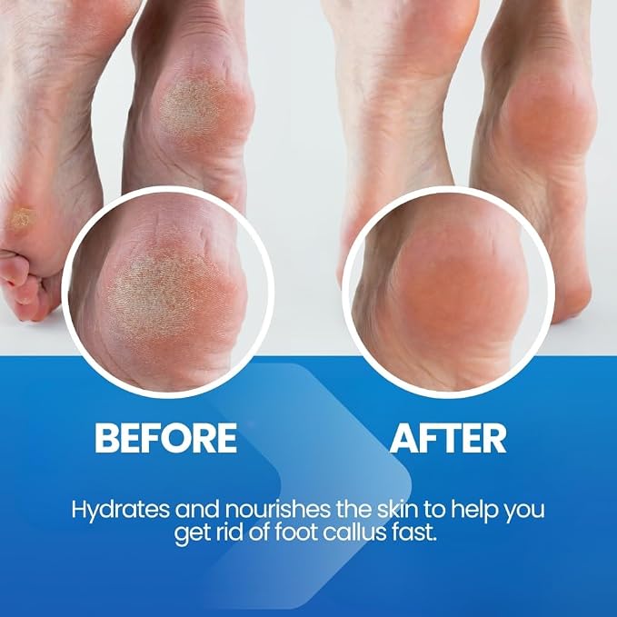 Imperial Feet Callus Softener Spray - Image 2