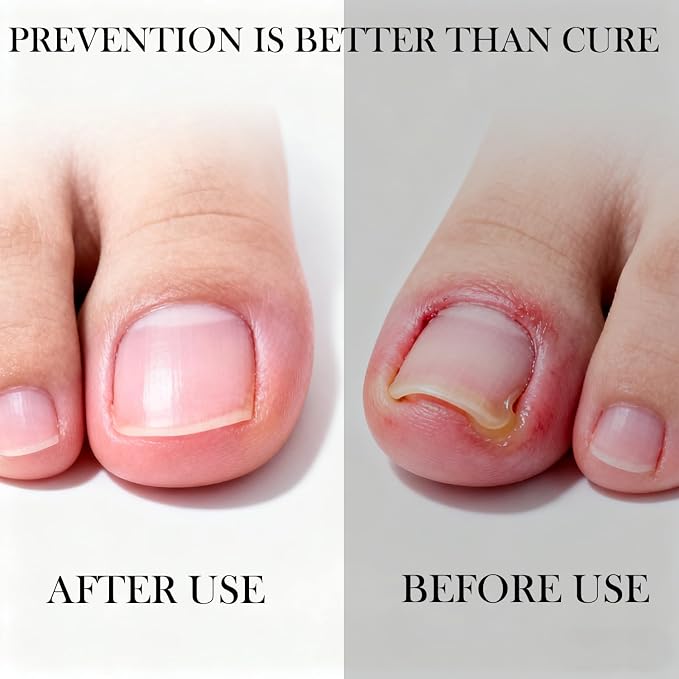 Ingrown Toenail Corrector Set - Image 7