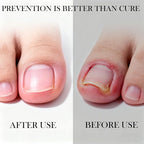 Ingrown Toenail Corrector Set - Image 7