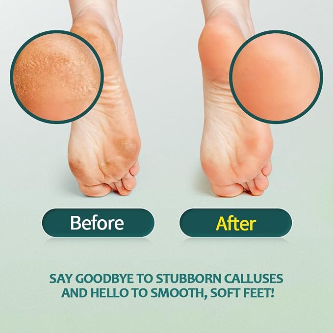 Gorgellux Callus Remover for Feet, Callus Remover Gel & Foot File Kit, Foot - Image 2