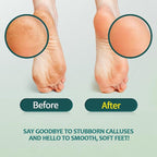 Gorgellux Callus Remover for Feet, Callus Remover Gel & Foot File Kit, Foot - Image 2