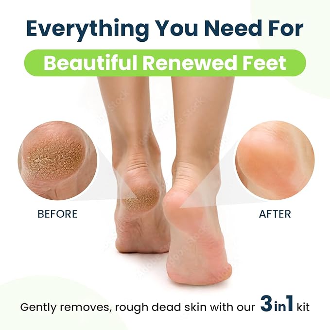 Callus Remover for Feet with Extra Strength Gel & Foot Pumice Stone Set - Image 5