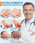 MQFORU Liquid Corn & Callus Removers - Image 7