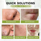 SHVYOG Blackhead Peel Off Face Mask, 3-in-1 Blackhead Remover Mask - Image 5