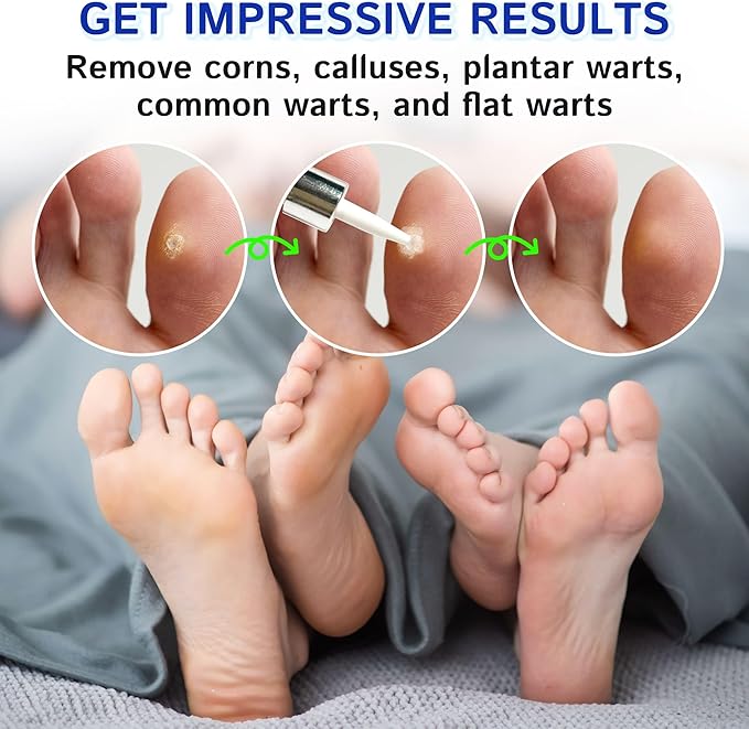 Ulensy Corn Remover Liquid for Toes Feet: 20ml Salicylic Acid for Foot Corns - Image 6
