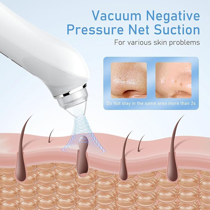 Facial Pore Blackhead Remover Vacuum, 1080P Camera Blackhead Remover, 20x Zoom - Image 2