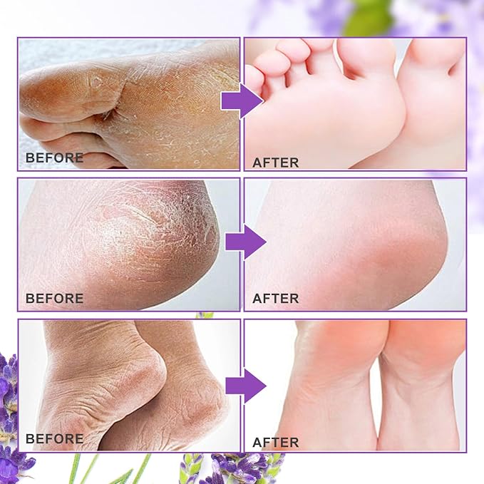 ALIVER Foot Peel Mask 3 Pack, Exfoliator Peel Off Calluses Dead Skin Callus - Image 5