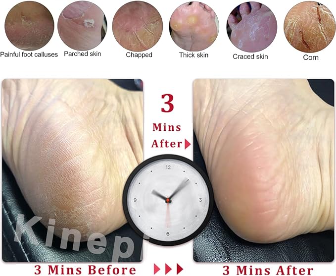 Kinepi Feet Callus Removers Professional Colossal Foot Scrubber Pedicure Foot - Image 4