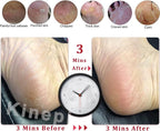 Kinepi Feet Callus Removers Professional Colossal Foot Scrubber Pedicure Foot - Image 4