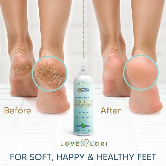 Callus Remover for Feet Foot Callus Remover Gel - Image 3