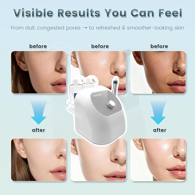 Hydrogen Oxygen Facial Machine, Hydro Facial Machine & Hydrodermabrasion Machine - Image 4