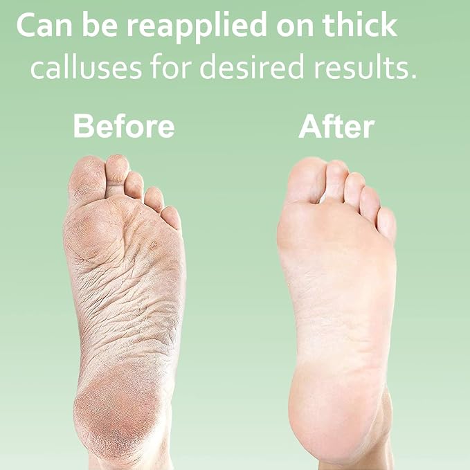 Dr. Entre's Callus Remover Gel Kit - Image 5