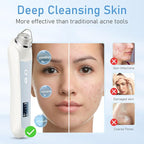 Facial Pore Blackhead Remover Vacuum, 1080P Camera Blackhead Remover, 20x Zoom - Image 4