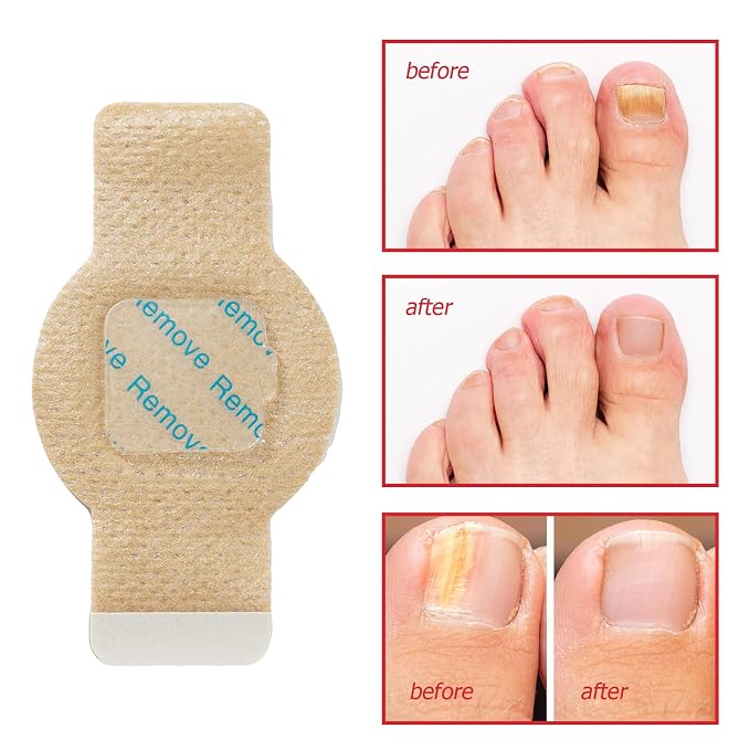 Fungal Nail Patches -Toenail Treatment Extra Strength 21Pcs- Nail Repair - Image 2