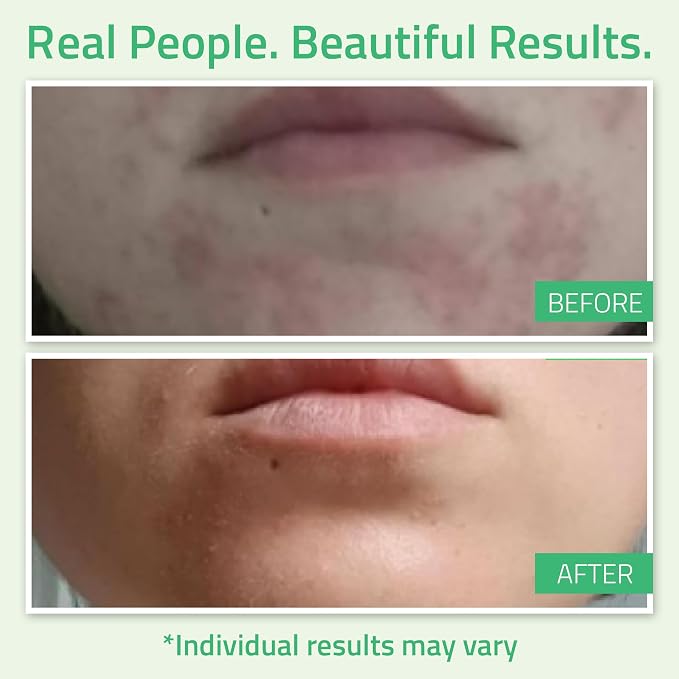 YEOUTH Glycolic Acid Peel for Face, At Home Chemical Exfoliator AHA 30% - Image 4
