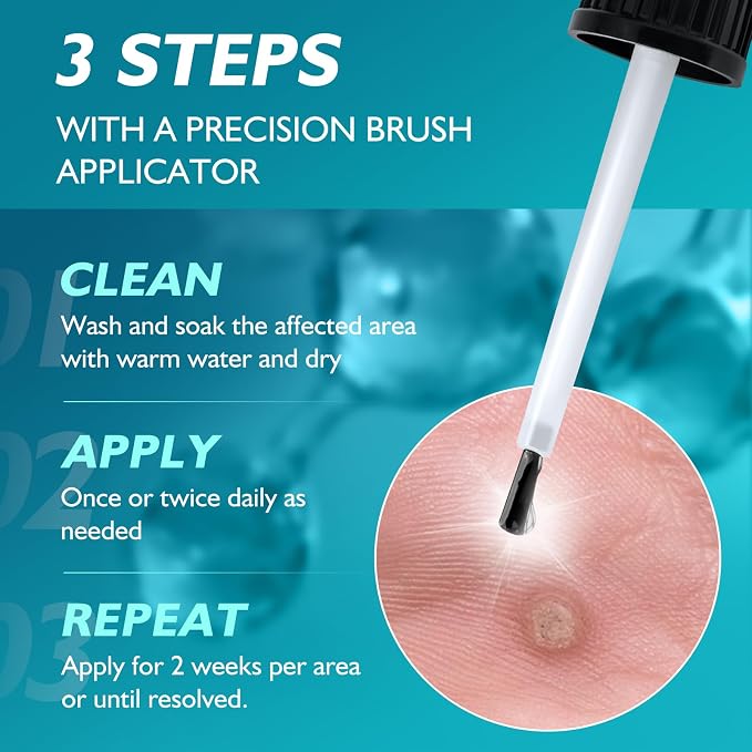 Wart Remover Freeze Off, Wart Corn Removers - Image 7