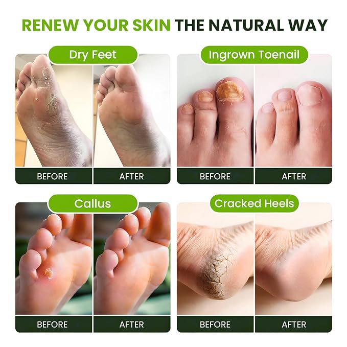 Tea Tree Oil Foot Soak with Epsom Salt - Image 5