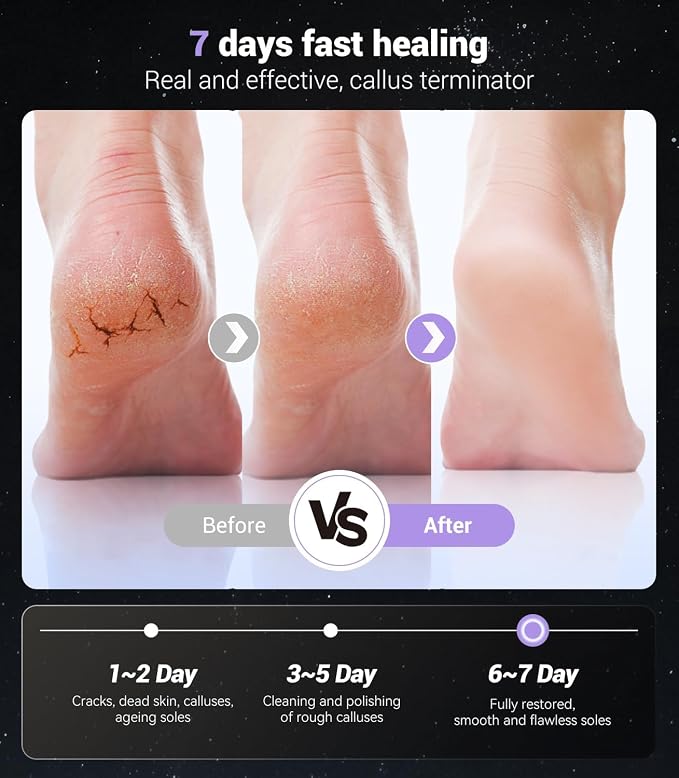 5-in-1 Professional Electric Callus Remover, Removes 99.92% of Calluses in 3 - Image 5