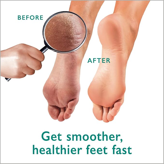 Callus Remover Gel + Foot Scrubber Kit - Image 7