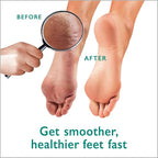 Callus Remover Gel + Foot Scrubber Kit - Image 7