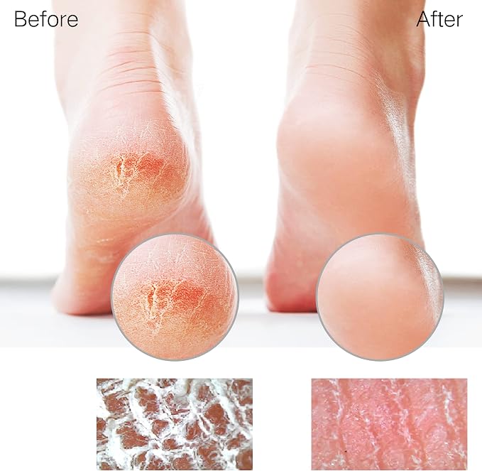 Glass Foot File Callus Remover for Feet, Heel Scraper, Pumice Stone, Diabetic - Image 4