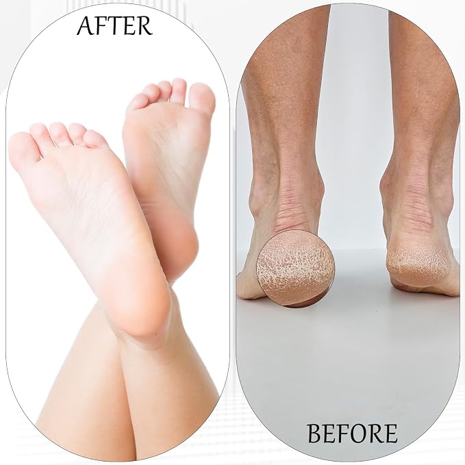 8 PCS Foot File, Callus Remover - Image 7