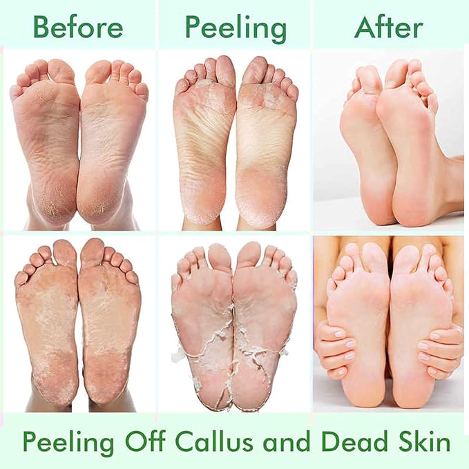 5 Pack Foot Peeling Mask, Exfoliator Peel Off Calluses Dead Skin Callus Remover - Image 4
