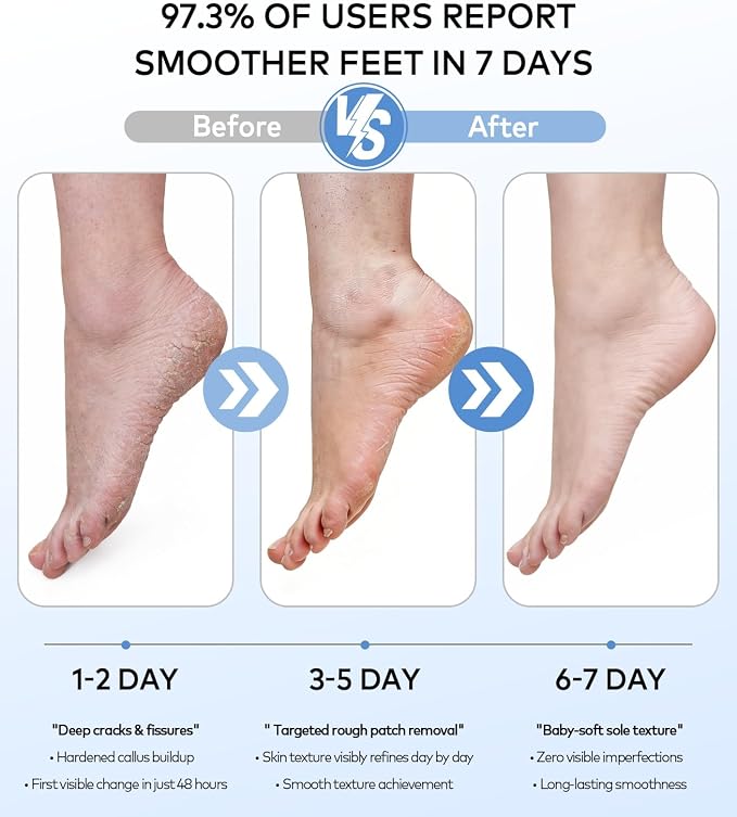 Rechargeable Electric Callus Remover - Image 3
