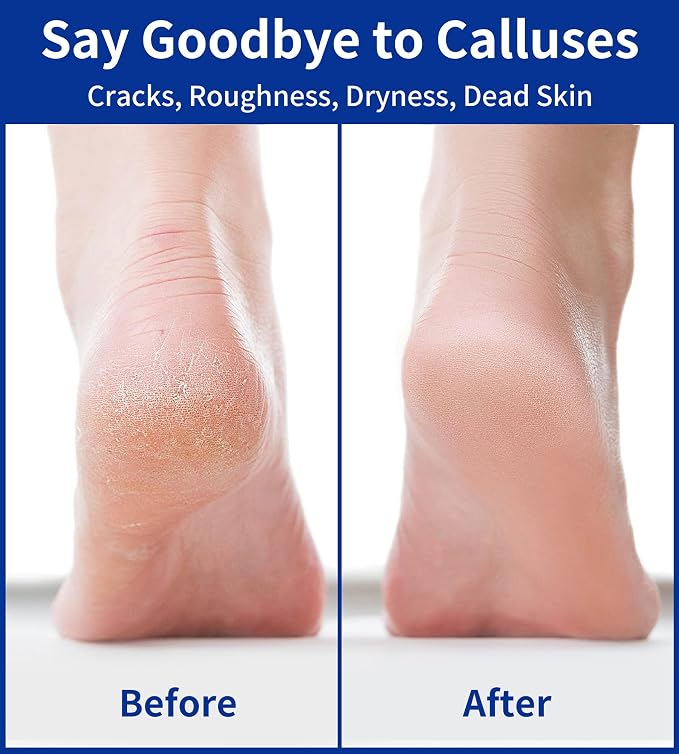 Nano Glass Foot File, Double-Sided Foot Callus Remover Feet Scrubber Hard & - Image 6