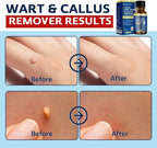 MEOLY Fast-Acting Wart Remover Freeze Off : Salicylic Acid Wart Remover - Image 4