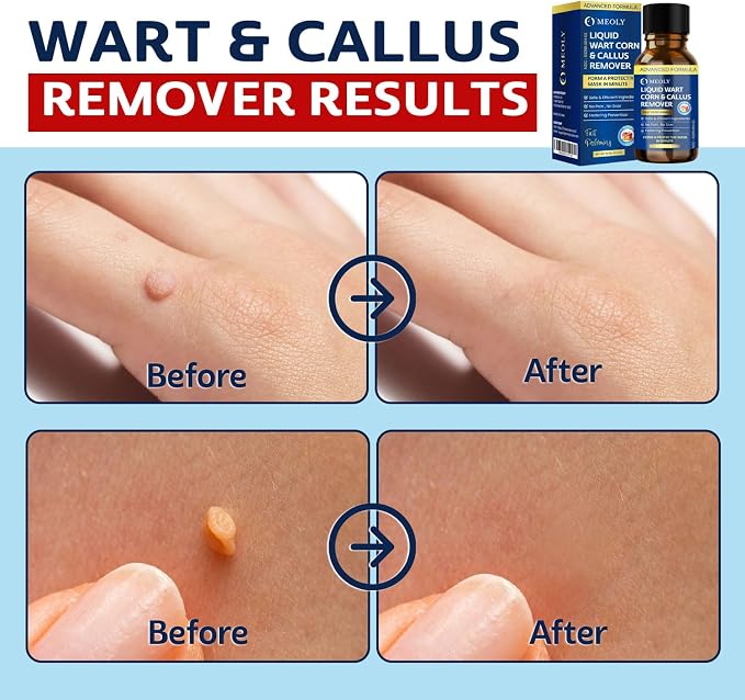 MEOLY Fast-Acting Wart Remover Freeze Off : Salicylic Acid Wart Remover - Image 4