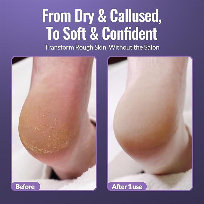 Footlogix Foot Care Callus Softener Combo - Image 6