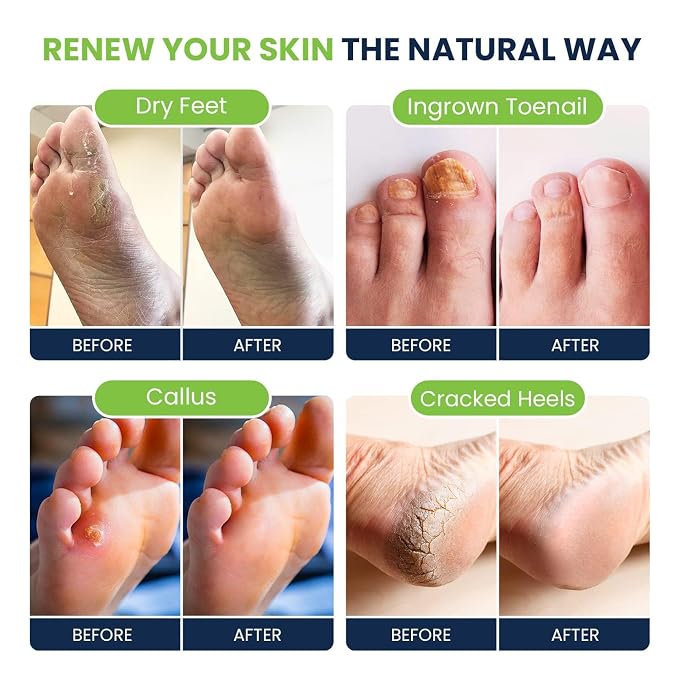 Tea Tree Foot Soak, Callus Remover Gel - Image 8