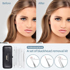 JPNK Blackhead Remover Comedone Extractor Acne Removal Kit.. - Image 2