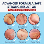 MEOLY Fast-Acting Wart Remover Freeze Off : Salicylic Acid Wart Remover - Image 2